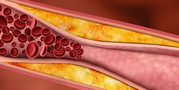 kolestrole bağlı damar sıkışması
